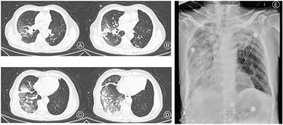 Clinical characteristics and prognosis of SARS-CoV-2 infection in lung transplant recipients